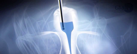 Endodoncia en Cerdanyola del Vallès Endodoncia en Cerdanyola del Vallès