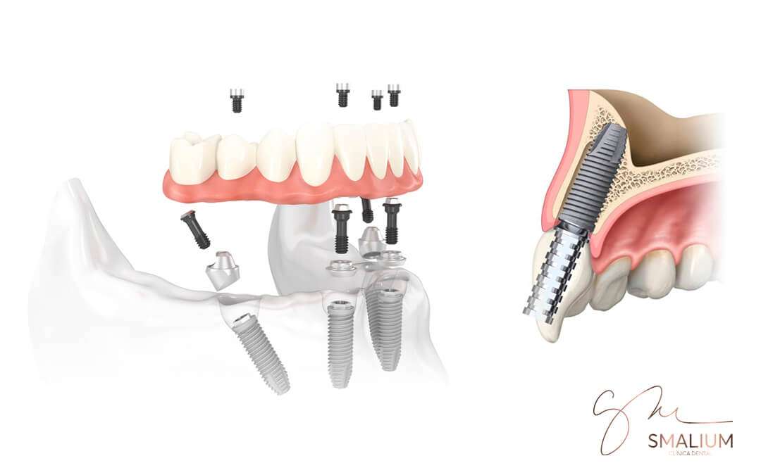 implantes-dentales-tipos