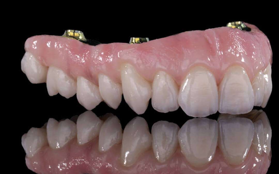 Sobredentadura sobre implantes dentales