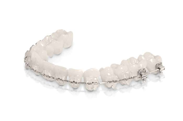 brackets-esteticos-convencionales-ceramicos-ortodoncia-SMALIUM