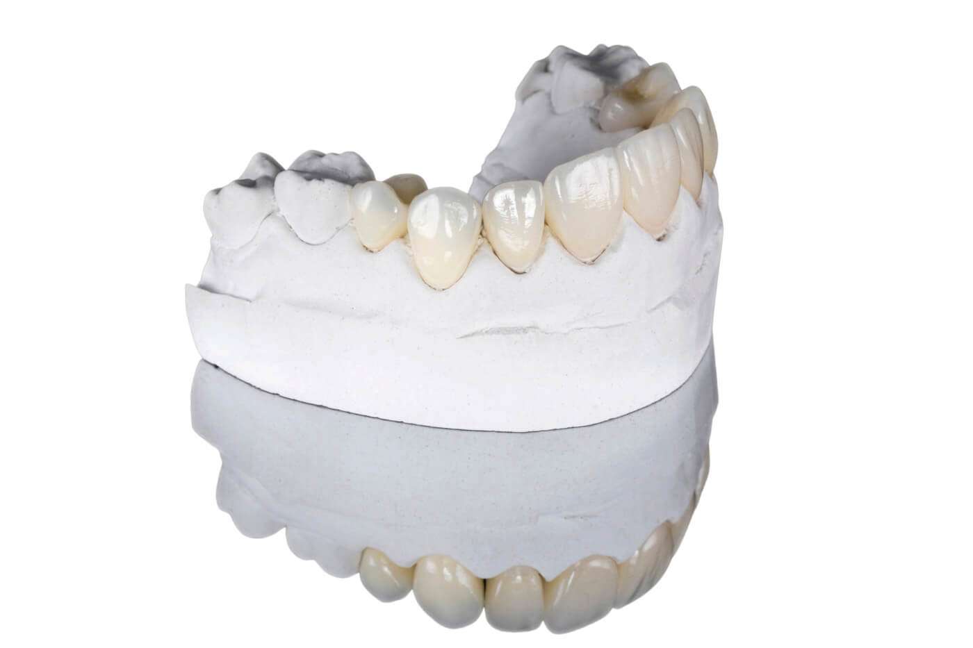 carillas-dentales-ceramica-porcelana-cerdanyola-SMALIUM