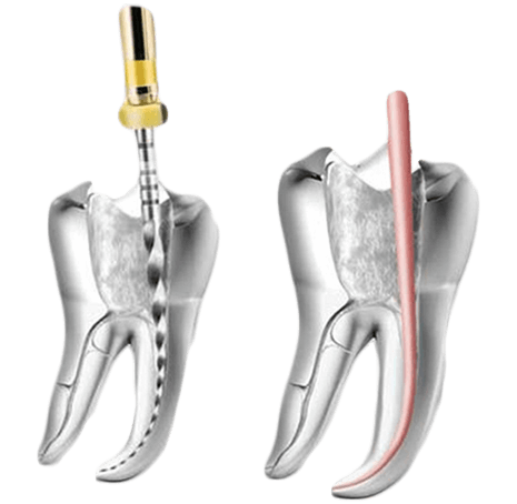endodoncia-clinica-dental-SMALIUM-Cerdanyola-del-valles