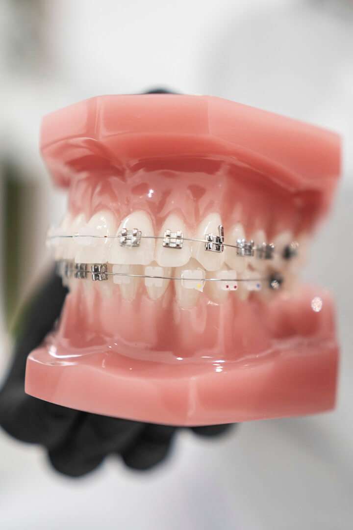 ortodoncia-con-brackets-en-cerdanyola-sant-cugat-SMALIUM