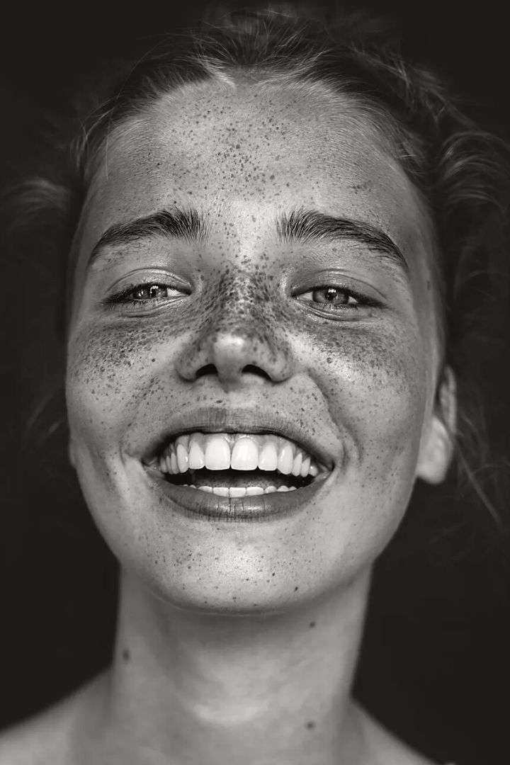 Diseño de Sonrisas Naturales en Cerdanyola - SMALIUM