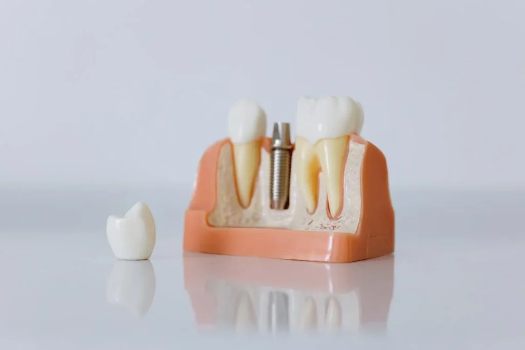 Fases de los implantes dentales