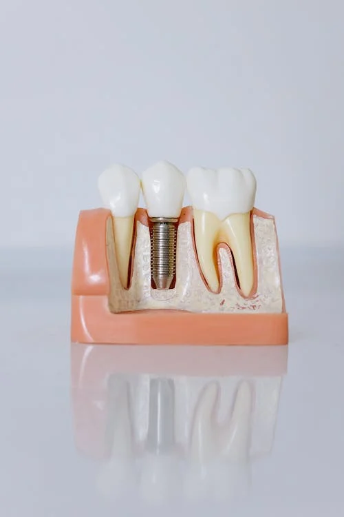 Fases de los implantes dentales