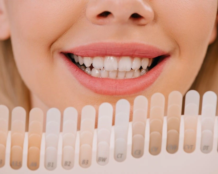 ¿Cuánto cuesta un blanqueamiento dental?