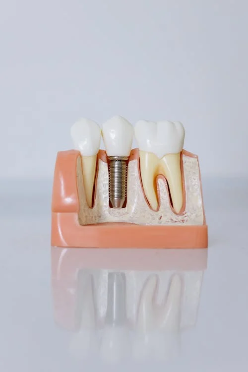 implantes dentales